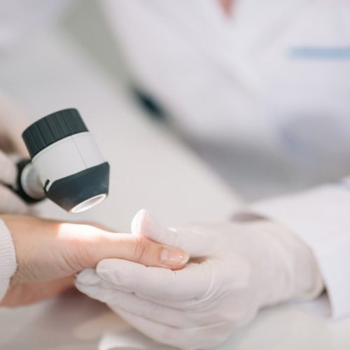 Closeup,Of,Dermatologist,Examining,Mole,On,Hand,Of,Female,Patient